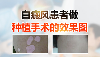 儿童腰部长白癜风擦他克莫司能治好吗