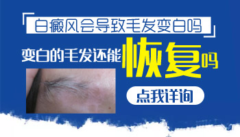 儿童额头长白癜风照308好还是uvb效果好