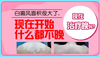 儿童腿上有白块做308激光照多长时间合适