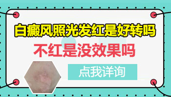 儿童脖颈长白癜风怎么治疗有康复案例吗