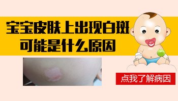 儿童鼻子长白癜风照308激光能治好吗