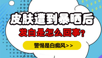 儿童鼻子长白癜风怎么回事