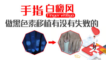 儿童腿上有片白照uvb一次要多少钱