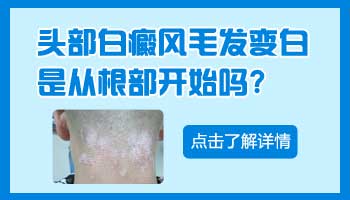 儿童下巴巴掌大白斑照激光一次需要多久