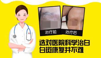 儿童鼻子长白癜风中西医结合治疗怎么样