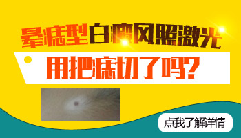 儿童脚部长白癜风只吃药不照光能好吗