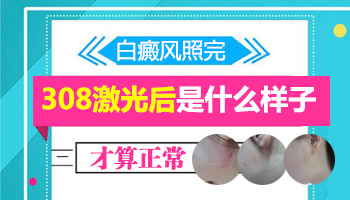 儿童手部有白斑一天照几次激光比较合适