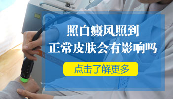 儿童肩膀长白癜风抹他克莫司多久能好