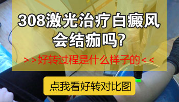 儿童面部长白癜风啥情况 怎么治疗