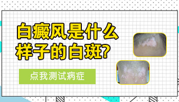 儿童腿上巴掌大白斑怎么回事