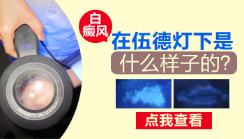 儿童手部长白癜风照308好还是uvb效果好