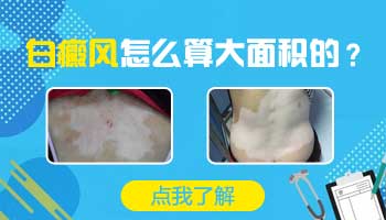儿童面部长白癜风只照308激光能控制住吗