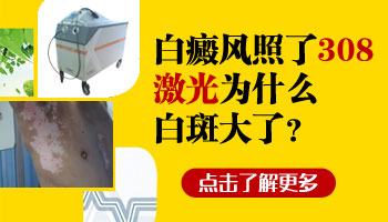 儿童手部长白癜风照完308红多久是正常的