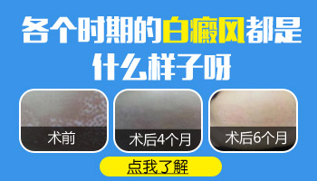 儿童眼处有片白啥情况 怎么治疗