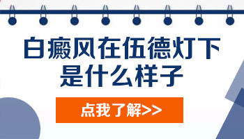 儿童腰部长白癜风照308激光能治好吗