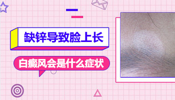 儿童胸部有白块擦他克莫司能治好吗