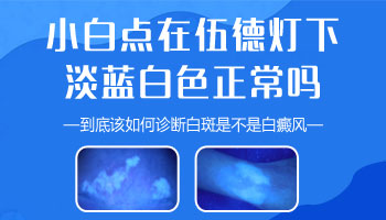 儿童手部有白斑照uvb一次要多少钱