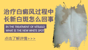儿童下巴长白癜风照308好还是uvb效果好
