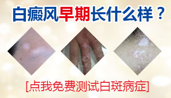 身上出现小块白癜风去邢台哪治疗能治好”