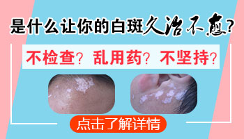 男孩脸上长白癜风照激光一次需要多久