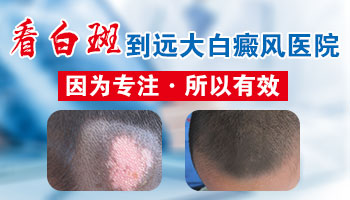 脸部长小面积白癜风去保定哪看比较好