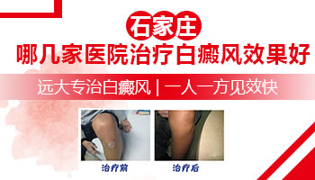身上有大片白癜风去石家庄哪看能治好
