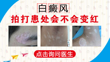 男孩脸上有片白如何诊疗