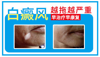 脸部有大面积白癜风去石家庄哪看比较好”