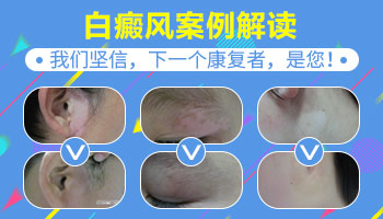 腹部长硬币大白癜风去邢台哪看能治好”