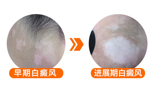 儿童脸上发现米粒大白斑照308好还是uvb效果好