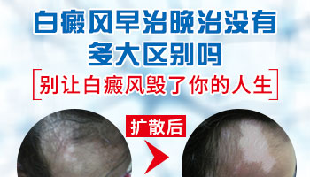 后背长鸡蛋大小白癜风去保定哪看效果好