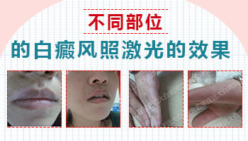 男孩脸上有一片白照308多久能看到效果