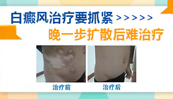 男孩脸上长白点中西医结合治疗怎么样