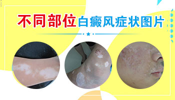 腹部长鸡蛋大小白癜风去石家庄哪看效果好”