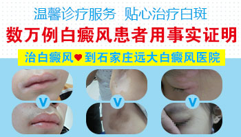 腰部发现扩散白癜风去保定哪治疗比较好”