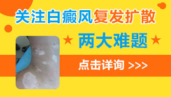 身上有泛发型白癜风去石家庄哪看比较好