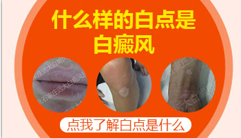 廊坊哪家医院治疗好白癜风花钱少