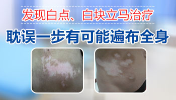 脖颈长黄豆大白癜风去张家口哪看比较好