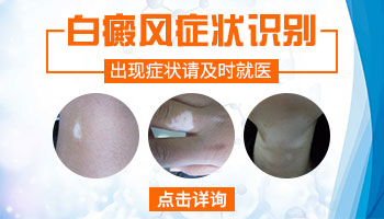 脸部有大片白癜风去衡水哪治疗能治好